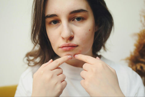 A woman with several acne spots, pinching a pimple.